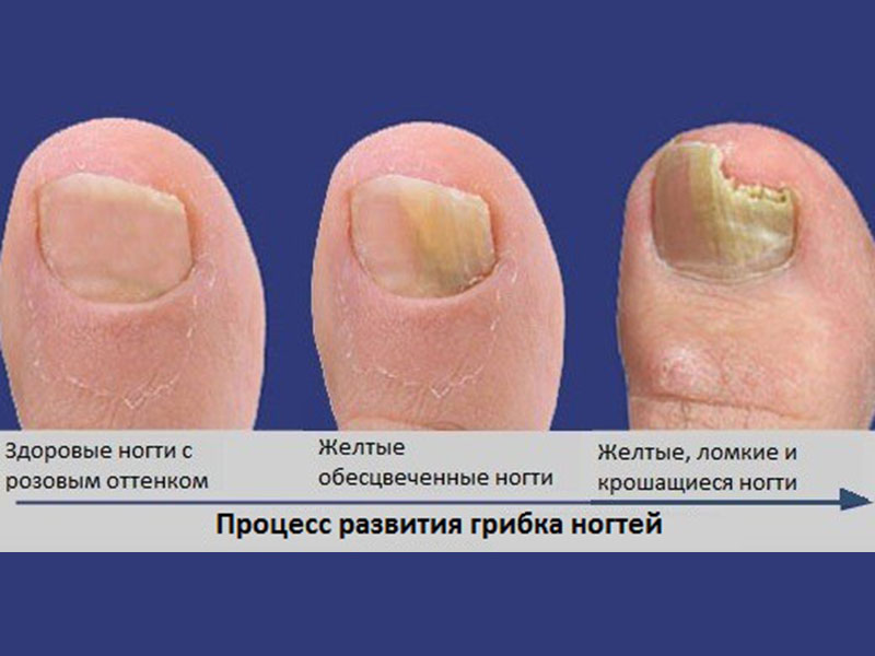 Грибок ногтей лечение препараты недорогие но эффективные 