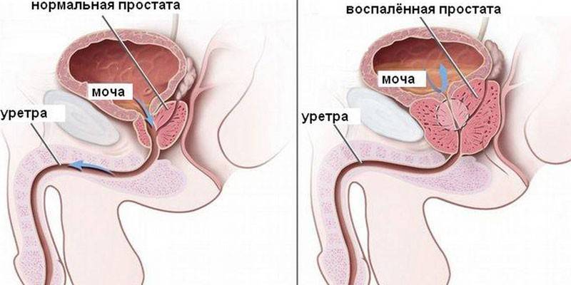 Антибиотики от уреаплазмы 