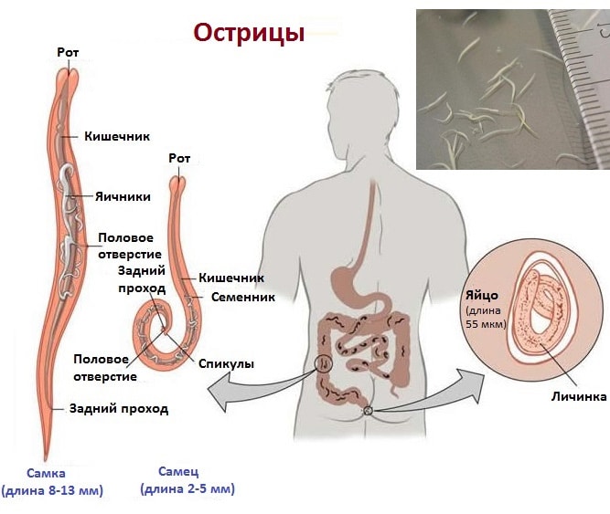 Быстро избавляемся от остриц у взрослых 