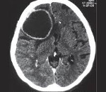 Диагностика и лечение эхинококкоза головного мозга у человека 