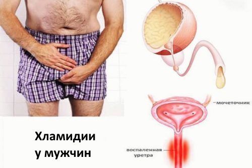 Фотографии симптомов хламидиоза у мужчин — без цензуры 