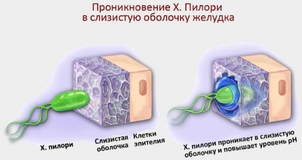 Хеликобактер пилори: симптомы и схемы лечения 