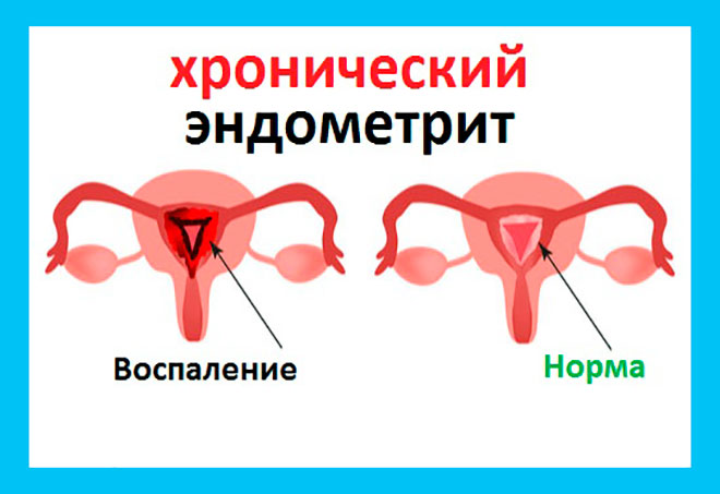 Хронический эндометрит и беременность 