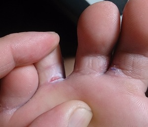 Лечение грибка между пальцами на ногах 