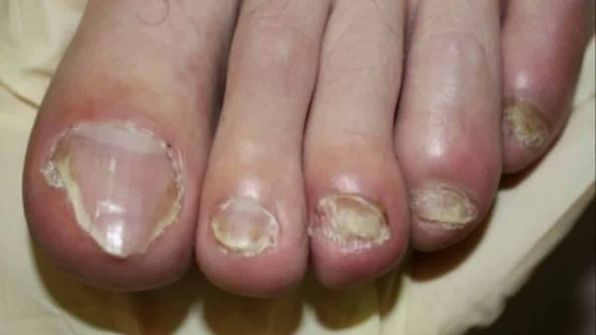 Мази от грибка ногтей на ногах 