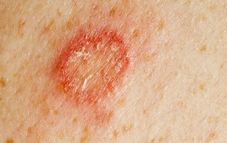 Микоз кожи — фото, симптомы и лечение по локализации, препараты 