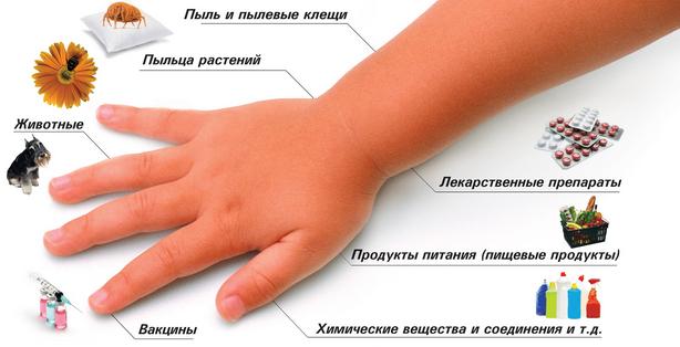 Могут ли глисты вызвать аллергию у детей и взрослых: взаимосвязь, симптомы и лечение 