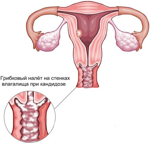 Обзор дешевых и эффективных таблеток от молочницы для женщин 