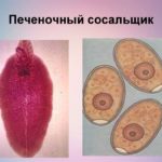 Печеночный сосальщик: симптомы и лечение 