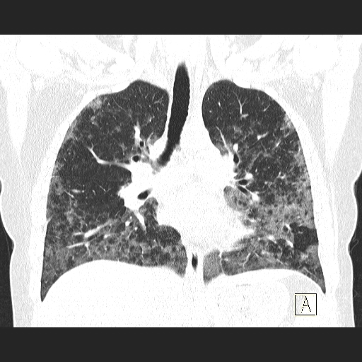 Пневмоцистная пневмония: симптомы и лечение, рентгенологическая картина 