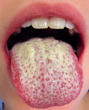 Почему появляется грибок во рту и как его лечить 