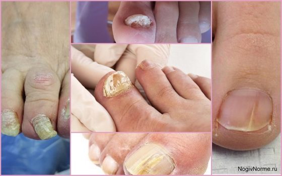 Симптоматика и лечение онихомикоза ногтей на ногах 
