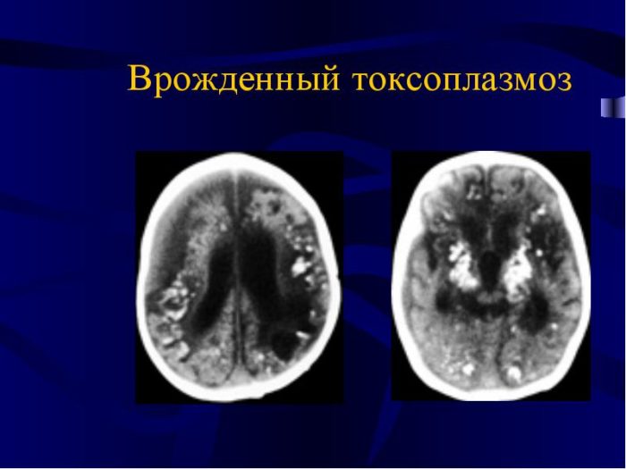 Токсоплазмоз у ребенка: риски при заражении в утробе матери и после рождения 