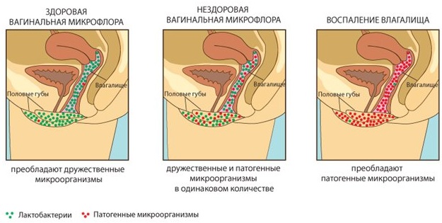 Уреаплазма у женщин: причины возникновения 23798 2 02.03.2017 