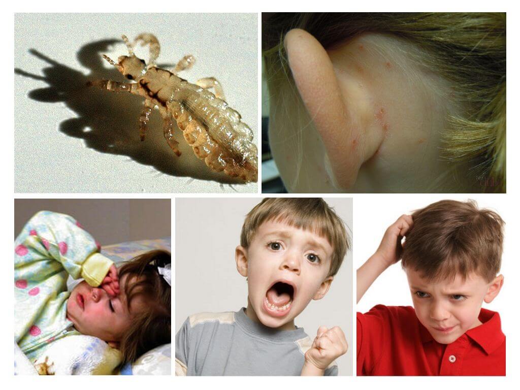 Вши в волосах: безобидная детская болезнь или проводник серьезных инфекций? 