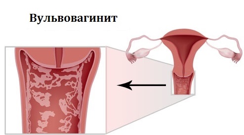 Вульвовaгинит у женщин и девочек: причины, симптомы и признаки, лечение 