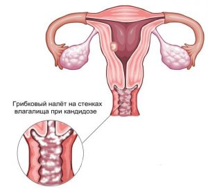 Выделения при молочнице: какие бывают, симптомы, фото 