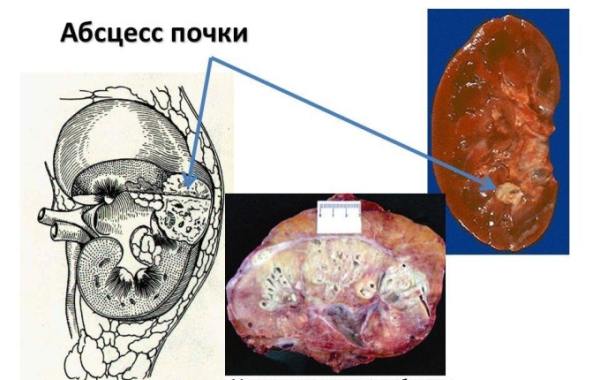 Абсцесс почки: причины возникновения, симптомы и лечение 