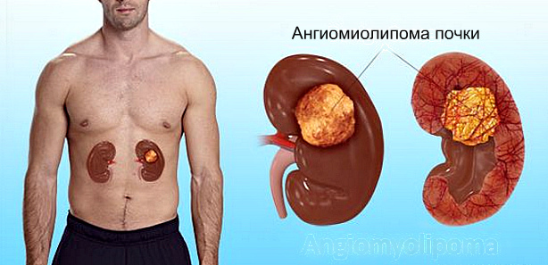 Ангиомиолипома почки: что это такое, причины, симптомы, как лечить 