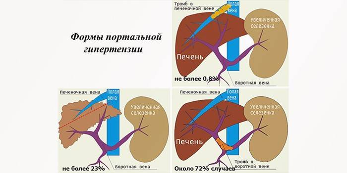 Билиарная гипертензия 