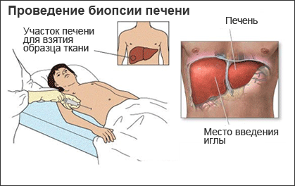 Биопсия печени. Эффективность метода в современных условиях 