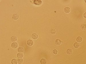 О чем свидетельствуют лейкоциты в моче: нормы и патологии 