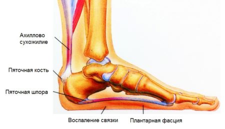 Помогает ли выполнение блокады от болей при пяточной шпоре 