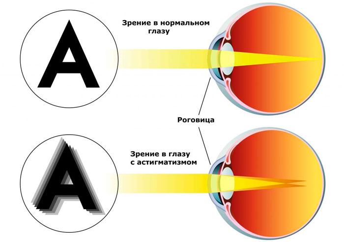 Как лечить астигматизм у взрослых — основные методы 