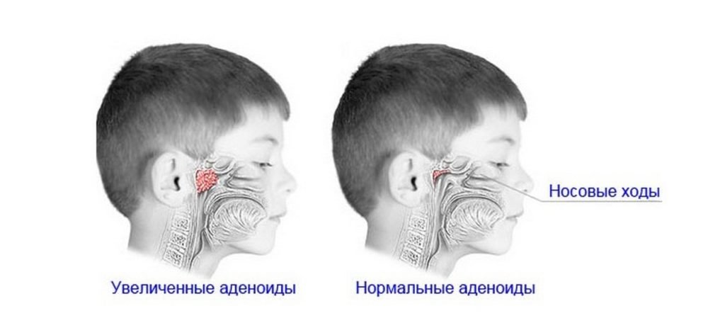 Аденоиды. Симптомы, причины воспаления, лечение и удаление аденоидов. 