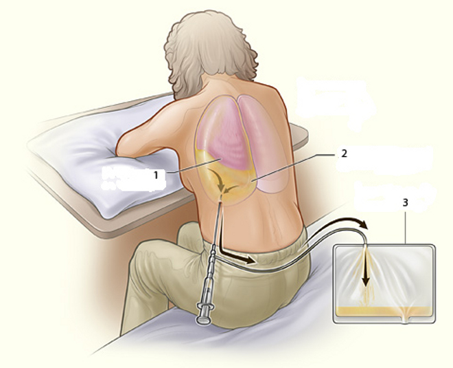 Алгоритм выполнения плевральной пункции 