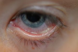 Белые выделения из глаз – почему возникают и каким образом их нужно лечить 