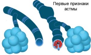 Бронхиальная астма — симптомы и лечение, признаки у взрослых 