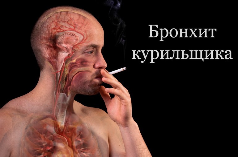 Бронхит курильщика – симптомы, лечение 