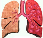 Бронхоэктатическая болезнь: симптомы и лечение 