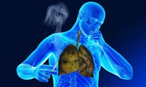 Чем и как лечить хронический бронхит курильщика? Лучшие аптечные лекарства и народные средства 