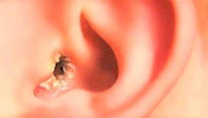 Чем лечить грибок в ушах? 