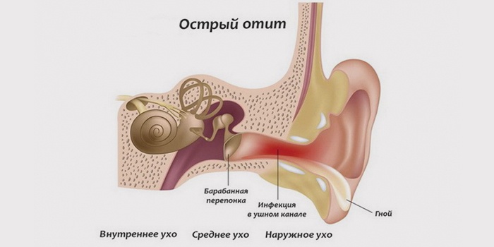 Чем опасен отит у детей и взрослых? 