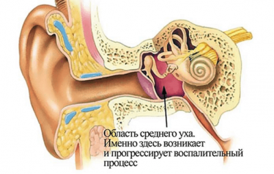 Что делать, если продуло ухо: симптомы и лечение в домашних условиях 