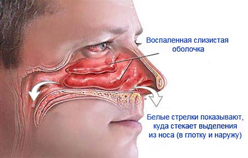 Что лучше помогает от насморка взрослым? 