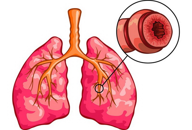 Что означает смешанная бронхиальная астма 