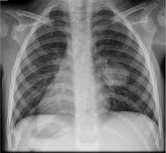 Что показывает рентген грудной клетки, когда может быть назначена процедура и как она проводится? 