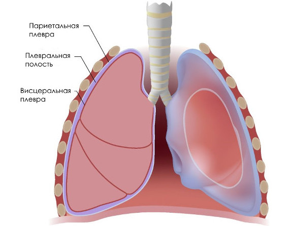 Что такое адгезивный плеврит и как его лечить 
