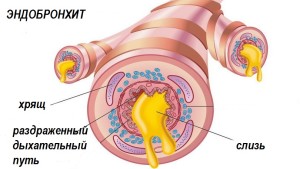 Что такое эндобронхит и как он лечится 