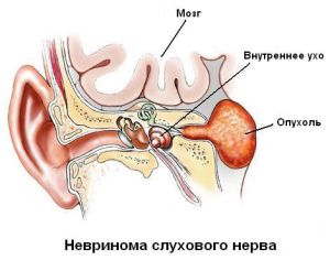 Что такое невринома слухового нерва — симптомы, диагностика и методы лечения 