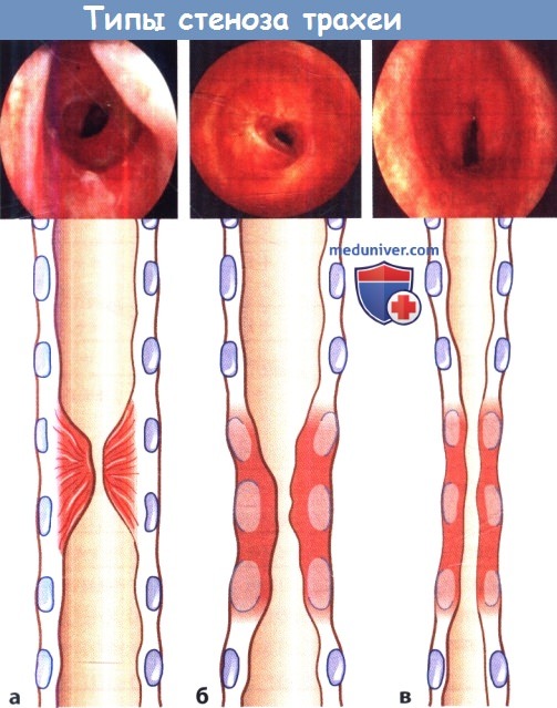 Диагноз стеноз трахеи 