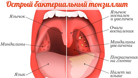 Диетическое питание при разных видах ангин 