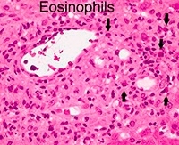Эозинофилия — причины повышения в крови. Как понизить эозинофилы в крови? 