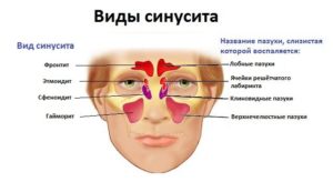 Фронтит: симптомы и лечение 21621 1 