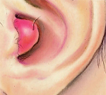Фурункулы в ушах: как от них избавиться и какие могут быть последствия 