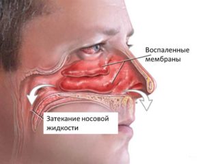 Гайморит: лечение антибиотиками. Название, капли, таблетки 